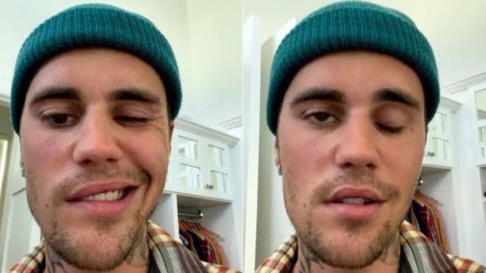 Justin Bieber's Face Is Paralyzed